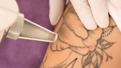 Clínicas de Eliminación de Tatuajes en Miraflores