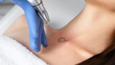Clínicas de Eliminación de Tatuajes en Pachacámac