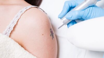 Clínicas de Eliminación de Tatuajes en Pucusana