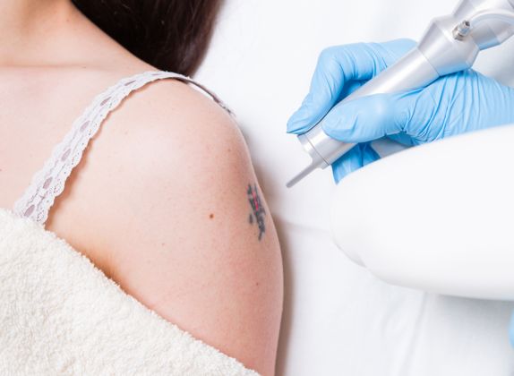 Clínicas de Eliminación de Tatuajes en Pucusana