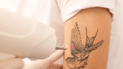 Clínicas de Eliminación de Tatuajes en Pueblo Libre