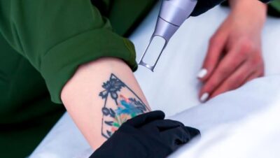 Clínicas de Eliminación de Tatuajes en Puente Piedra