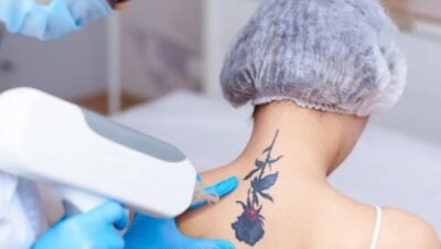 Clínicas de Eliminación de Tatuajes en Rímac