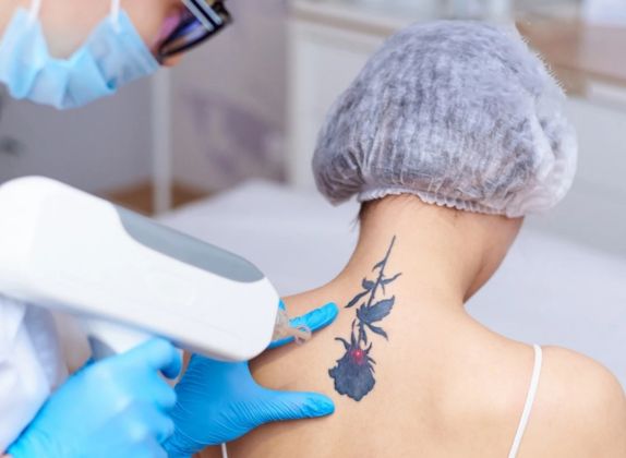 Clínicas de Eliminación de Tatuajes en Rímac