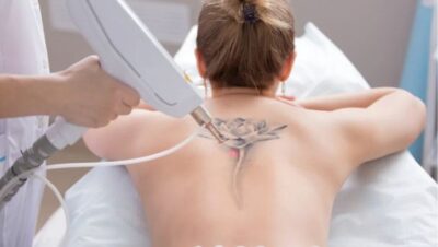Clínicas de Eliminación de Tatuajes en San Bartolo