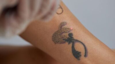 Clínicas de Eliminación de Tatuajes en San Isidro