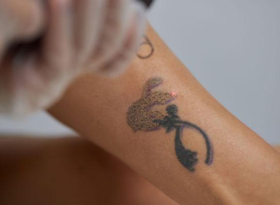 Clínicas de Eliminación de Tatuajes en San Isidro