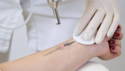 Clínicas de Eliminación de Tatuajes en San Miguel