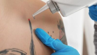 Clínicas de Eliminación de Tatuajes en Santa Anita