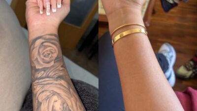 Clínicas de Eliminación de Tatuajes en Santa Rosa