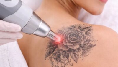 Clínicas de Eliminación de Tatuajes en Santiago de Surco