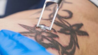 Clínicas de Eliminación de Tatuajes en Villa El Salvador