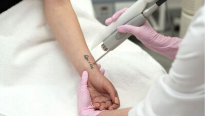 Clínicas de Eliminación de Tatuajes en Villa María del Triunfo